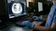 CT-Detected White Matter Disease Signals Higher Stroke/Dementia Risk Than MRI-Only Findings