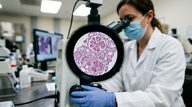 Telitacicept Reduces Proteinuria in IgA Nephropathy: Phase 3 Interim Analysis