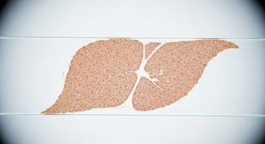 Liver Stiffness Better Reflects Cumulative Hepatic Injury Than Iron Concentration in Thalassemia
